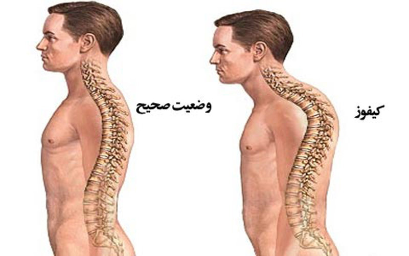 پاورپوینت پشت گرد (کیفوز پشتی)