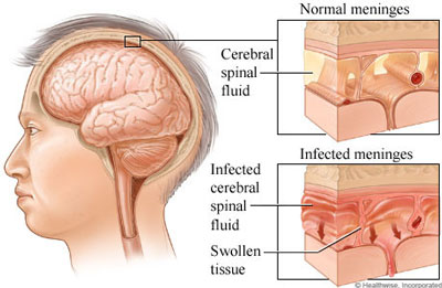 پاورپوینت مننژیت Meningiti