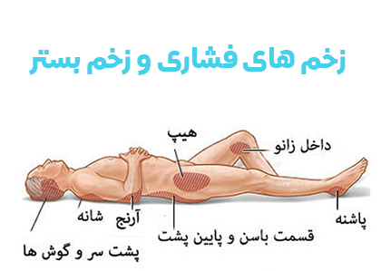 پاورپوینت مدیریت زخم های فشاری