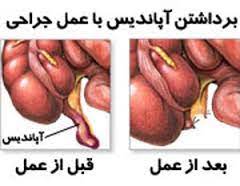 اسلاید آموزشی با عنوان موضوع آپاندیسیت درحاملگی و ضربه به شکم