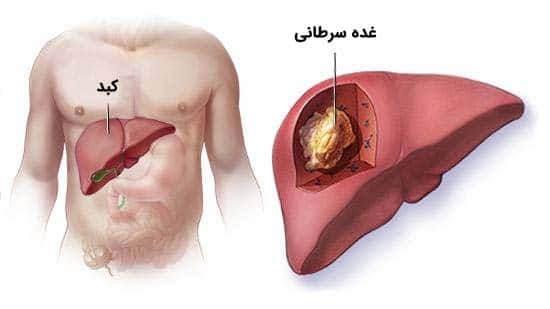 پاورپوینت سرطان کبد